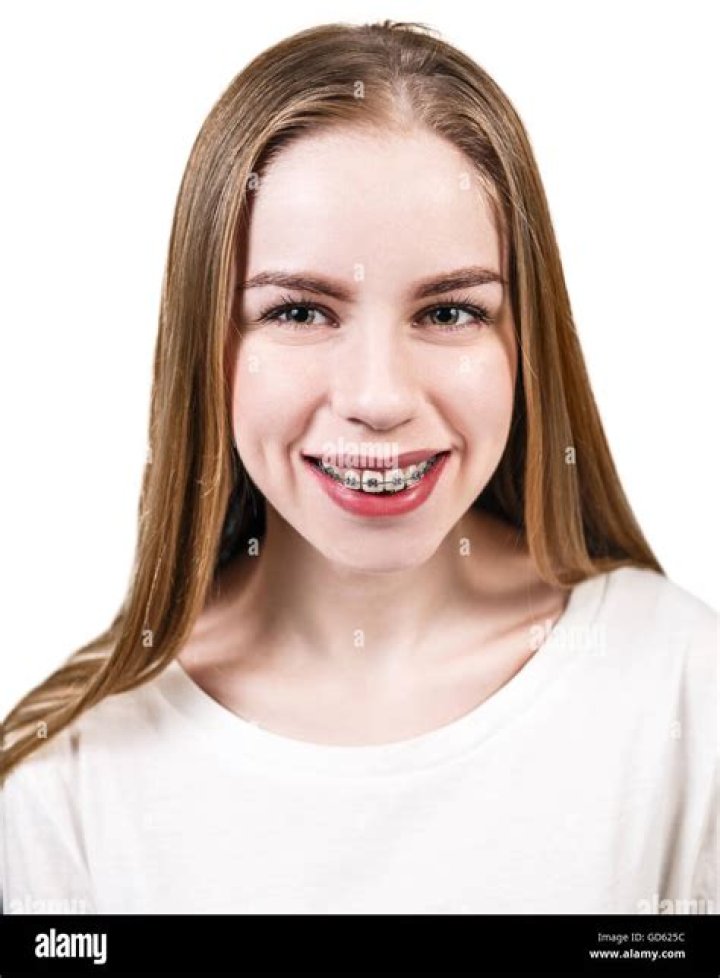 a woman with braces on her teeth posing for a photo in front of fireworks