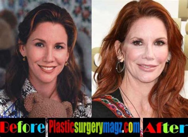 Melissa Gilbert Plastic Surgery Before and After YouTube